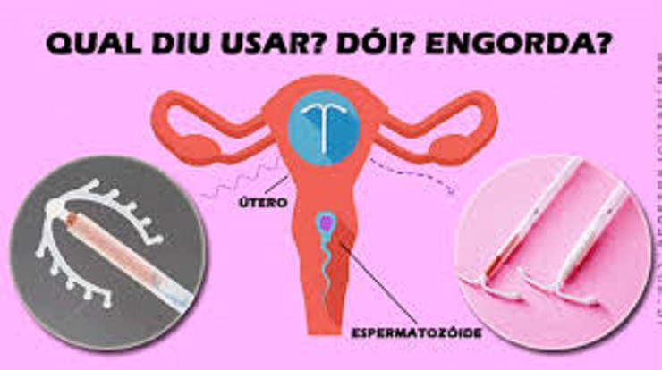 DIU \u2013 Qual escolher? Engorda? Descubra tudo sobre esse contraceptivo ...